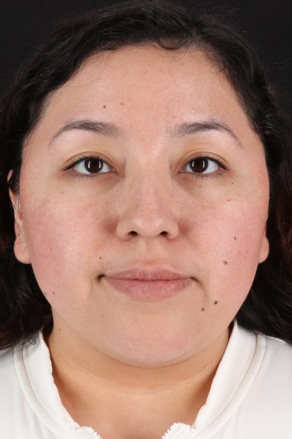 Rhinoplasty Before & After Patient #12447