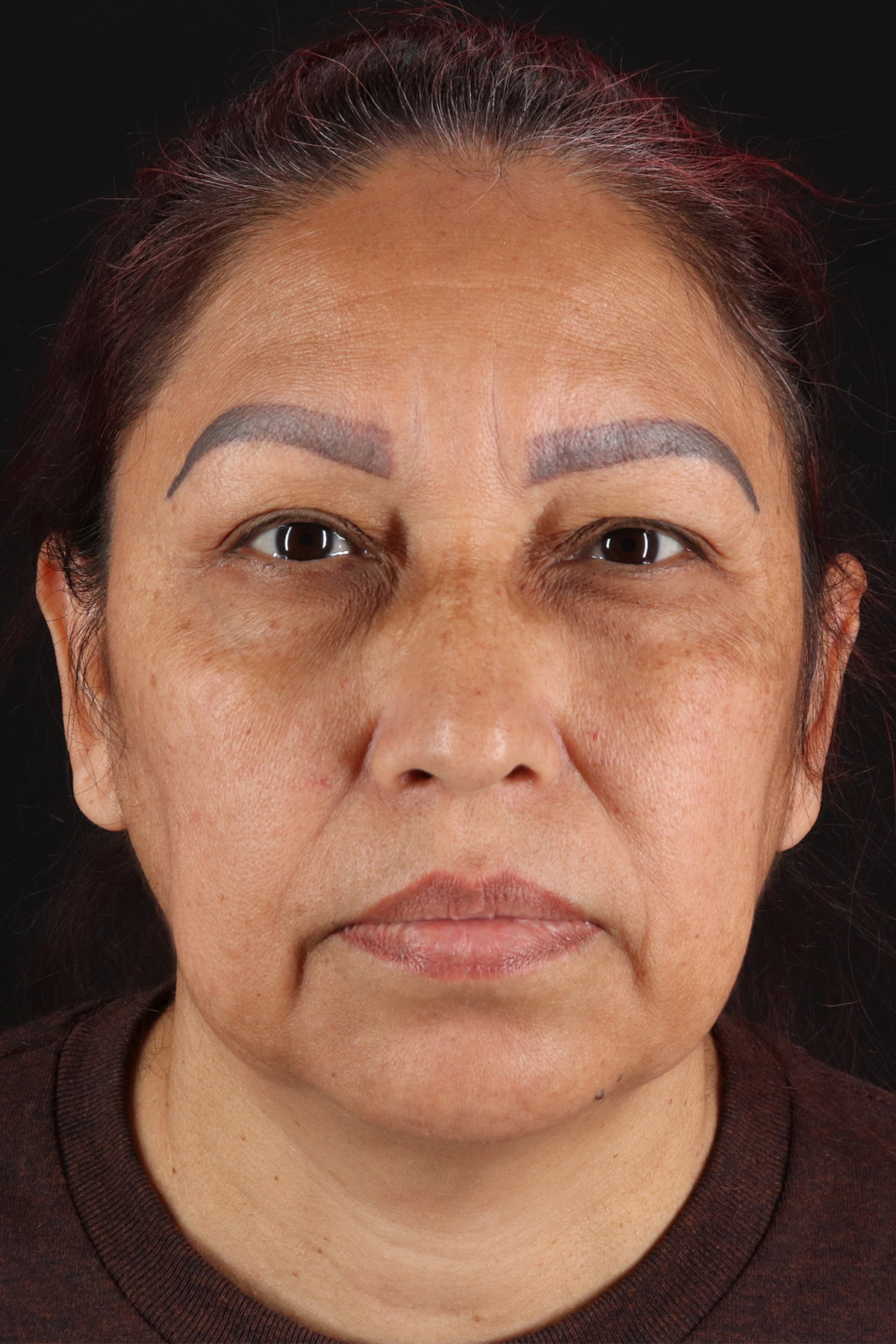 Lower Blepharoplasty Before & After Patient #13085