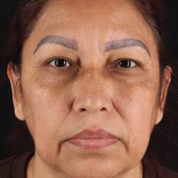 Upper Blepharoplasty Before & After Patient #12051