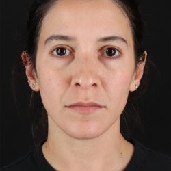 CO2 Laser Before & After Patient #11103
