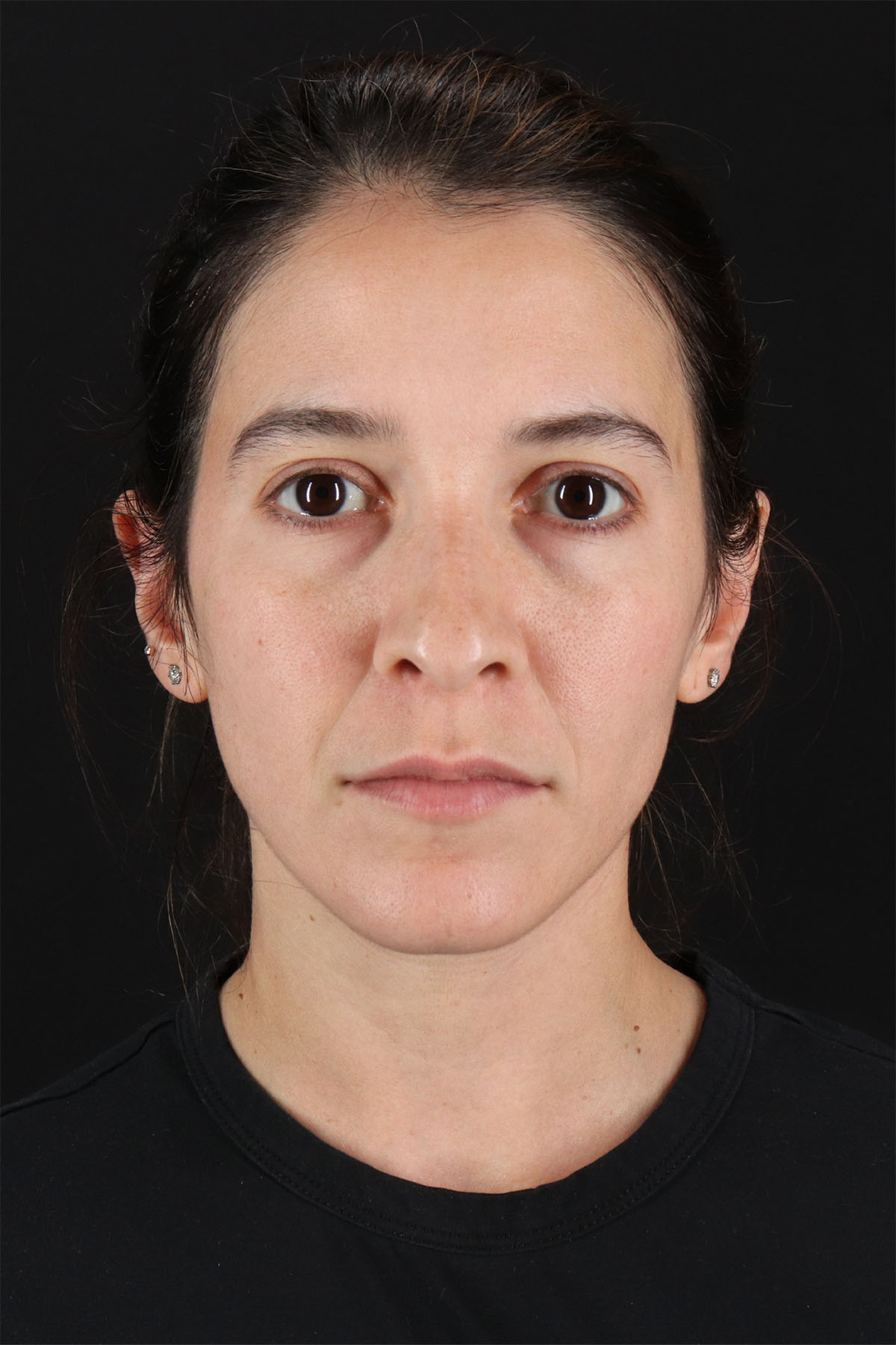 CO2 Laser Before & After Patient #11103