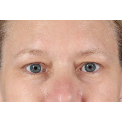 Blepharoplasty (Eyelid Surgery) Before & After Patient #10991