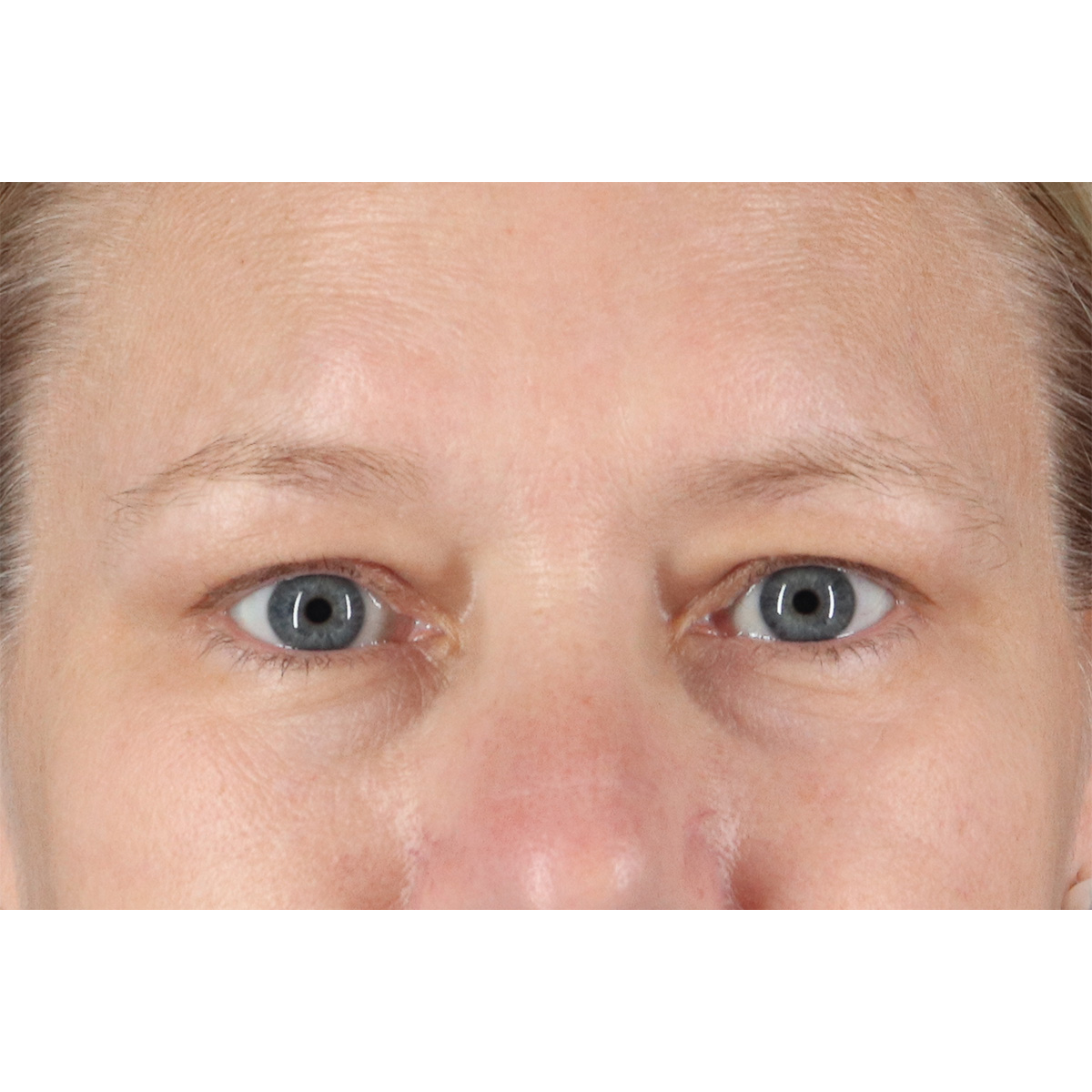 Blepharoplasty (Eyelid Surgery) Before & After Patient #10991