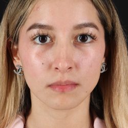 Rhinoplasty Before & After Patient #12216