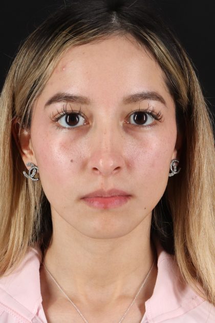 Rhinoplasty Before & After Patient #12216
