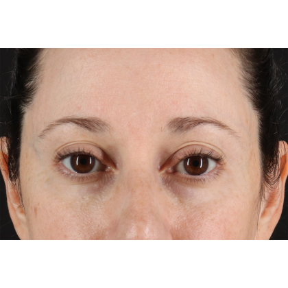 Blepharoplasty (Eyelid Surgery) Before & After Patient #11114