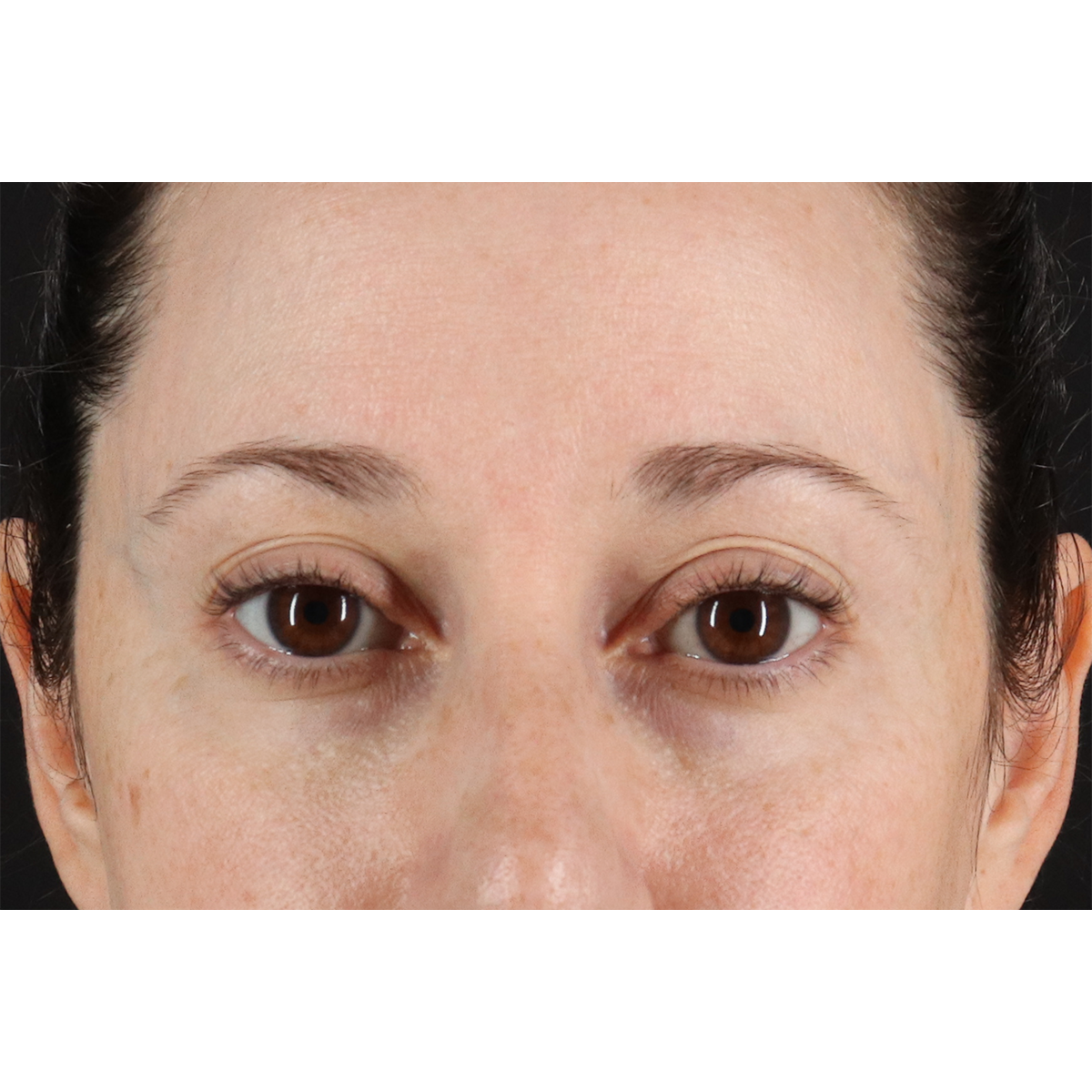 Blepharoplasty (Eyelid Surgery) Before & After Patient #11114