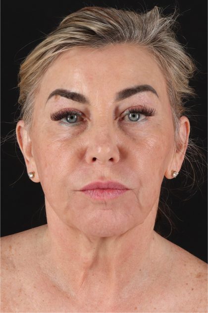 Fat Grafting To The Face Before & After Patient #11828