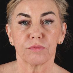 Facelift Before & After Patient #11462