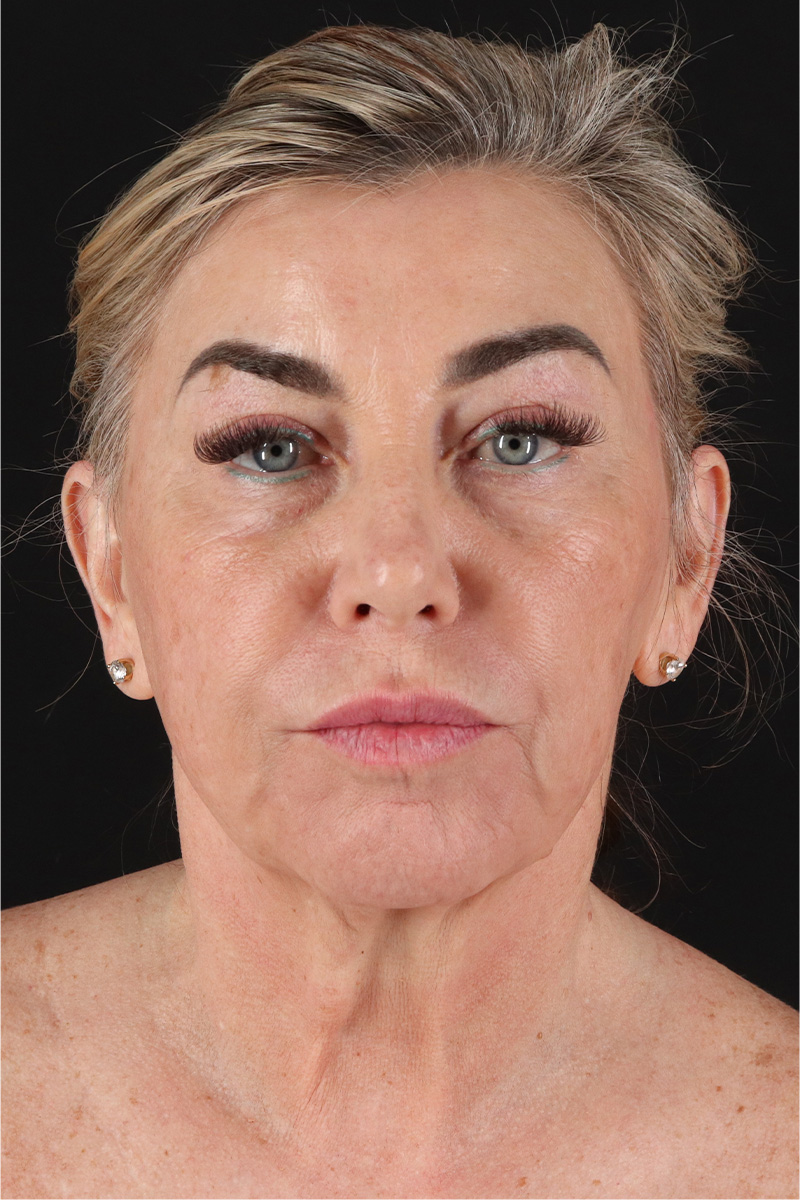 Facelift Before & After Patient #11462