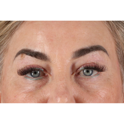 Blepharoplasty (Eyelid Surgery) Before & After Patient #11506