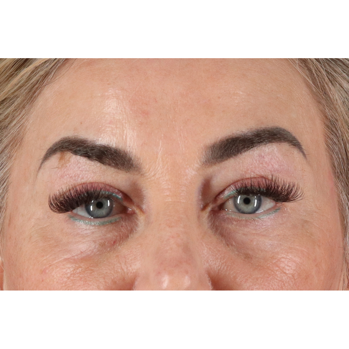 Blepharoplasty (Eyelid Surgery) Before & After Patient #11506