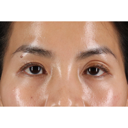 Blepharoplasty (Eyelid Surgery) Before & After Patient #10782
