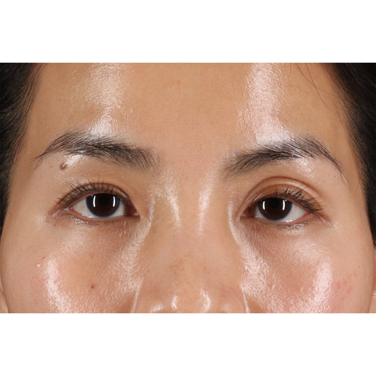 Blepharoplasty (Eyelid Surgery) Before & After Patient #10782