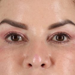 Rhinoplasty Before & After Patient #12656