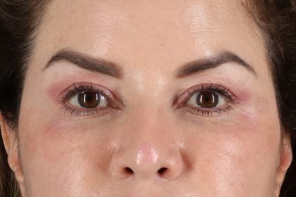 Upper Blepharoplasty Before & After Patient #12073