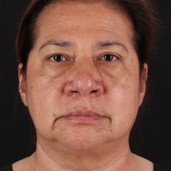 CO2 Laser Before & After Patient #11136