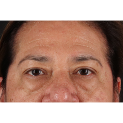 Blepharoplasty (Eyelid Surgery) Before & After Patient #11125