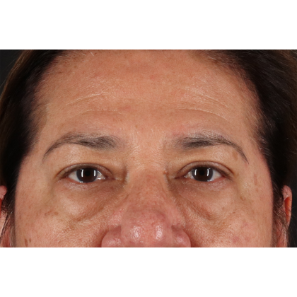 Blepharoplasty (Eyelid Surgery) Before & After Patient #11125