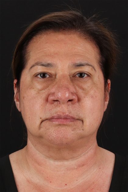 CO2 Laser Before & After Patient #11136