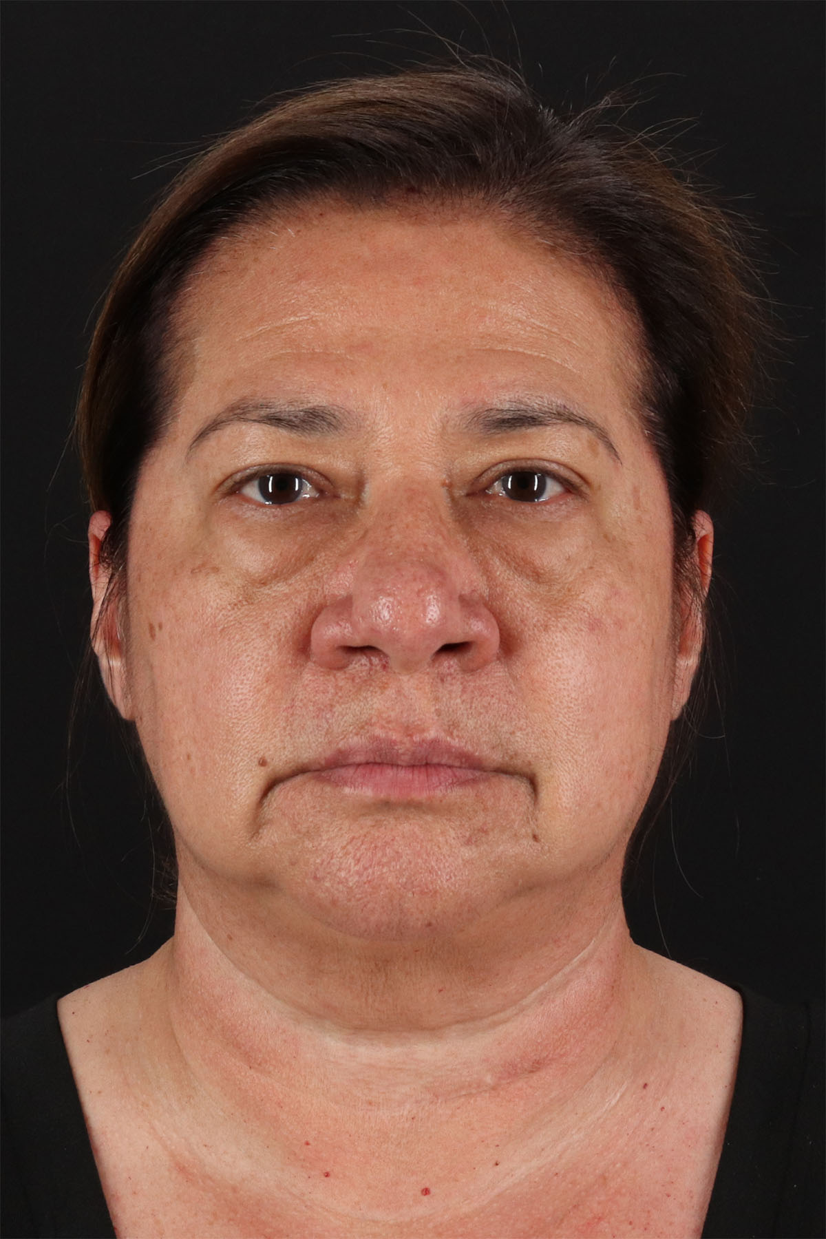 CO2 Laser Before & After Patient #11136