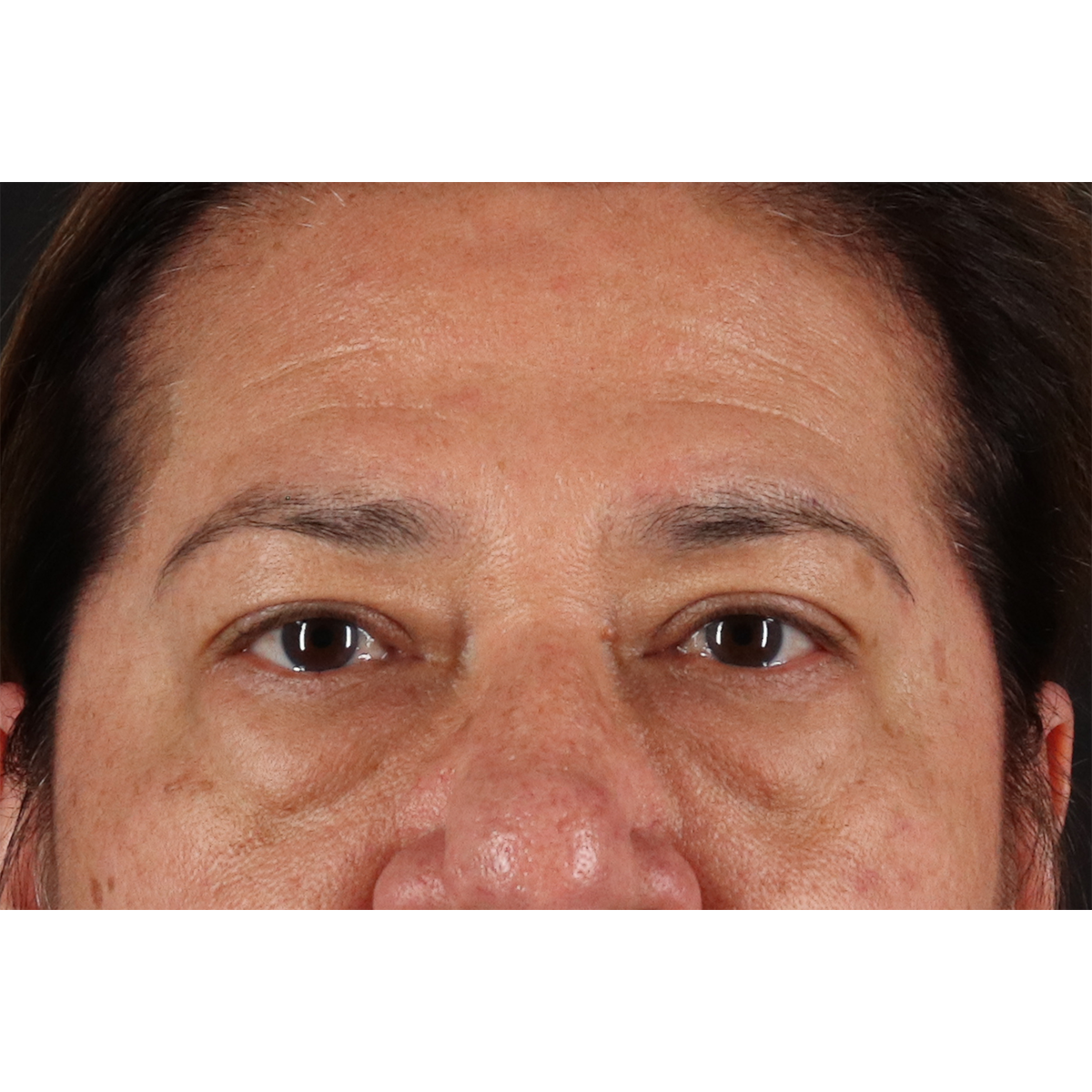 Blepharoplasty (Eyelid Surgery) Before & After Patient #11125
