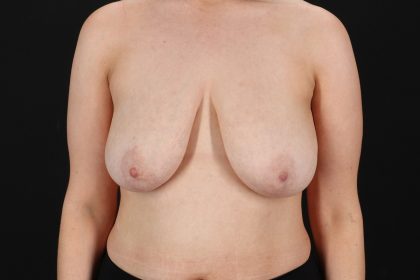 Breast Reduction With Lift Before & After Patient #11473