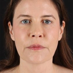 Fat Grafting To The Face Before & After Patient #11817
