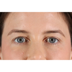 Blepharoplasty (Eyelid Surgery) Before & After Patient #11517