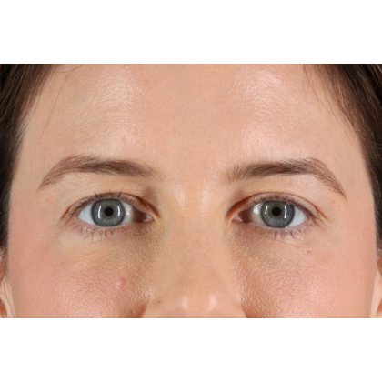 Blepharoplasty (Eyelid Surgery) Before & After Patient #11517