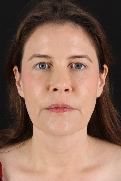 Fat Grafting To The Face Before & After Patient #11817