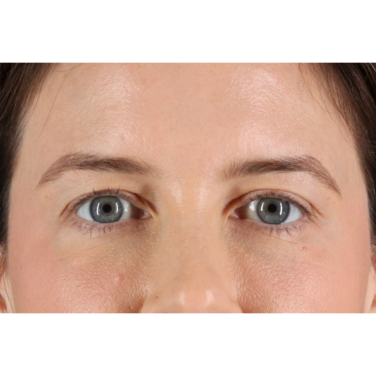 Blepharoplasty (Eyelid Surgery) Before & After Patient #11517