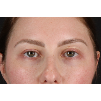 Brow Lift Before & After Patient #11657