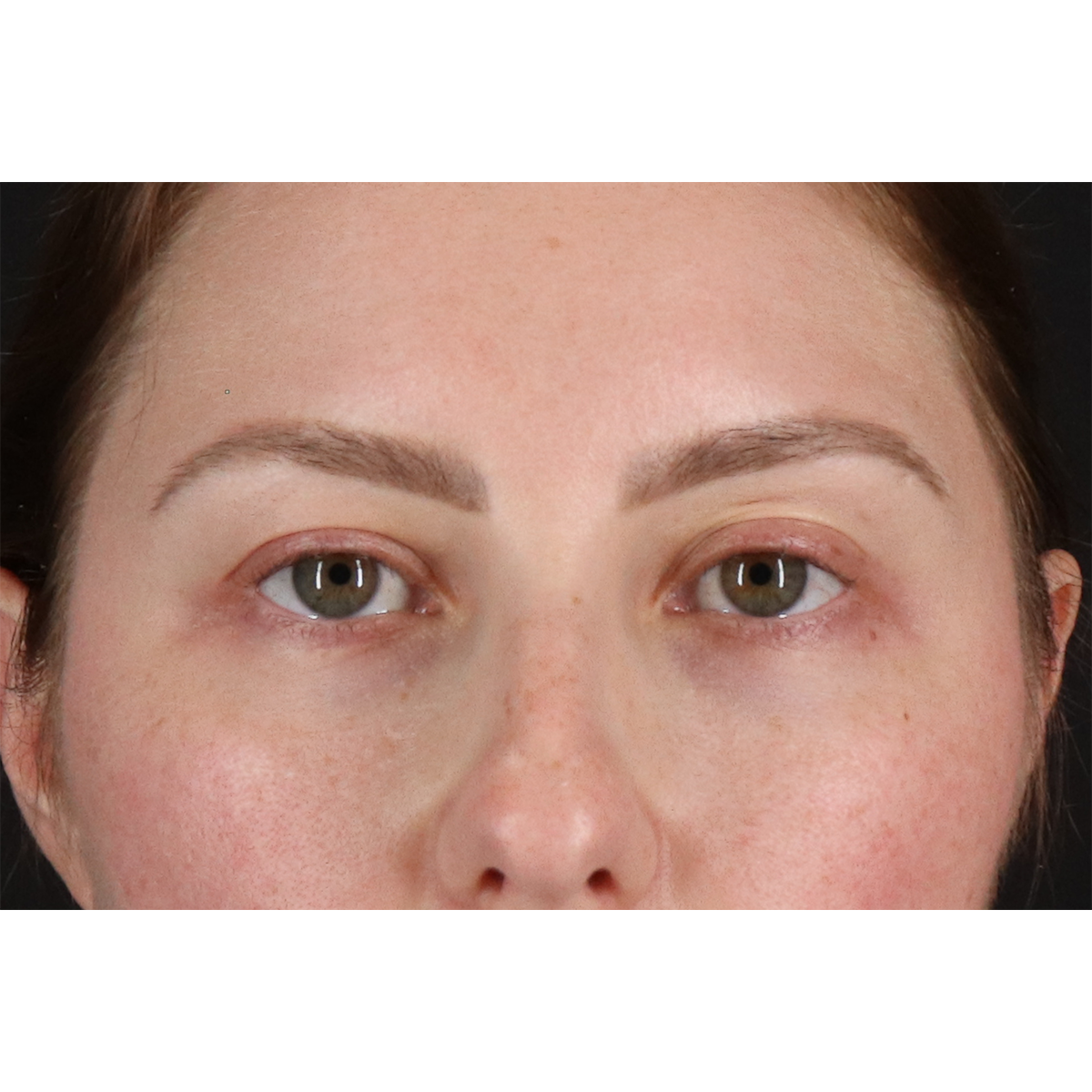 Brow Lift Before & After Patient #11657