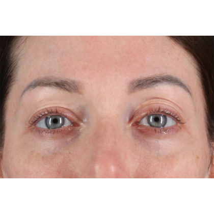 Blepharoplasty (Eyelid Surgery) Before & After Patient #11026
