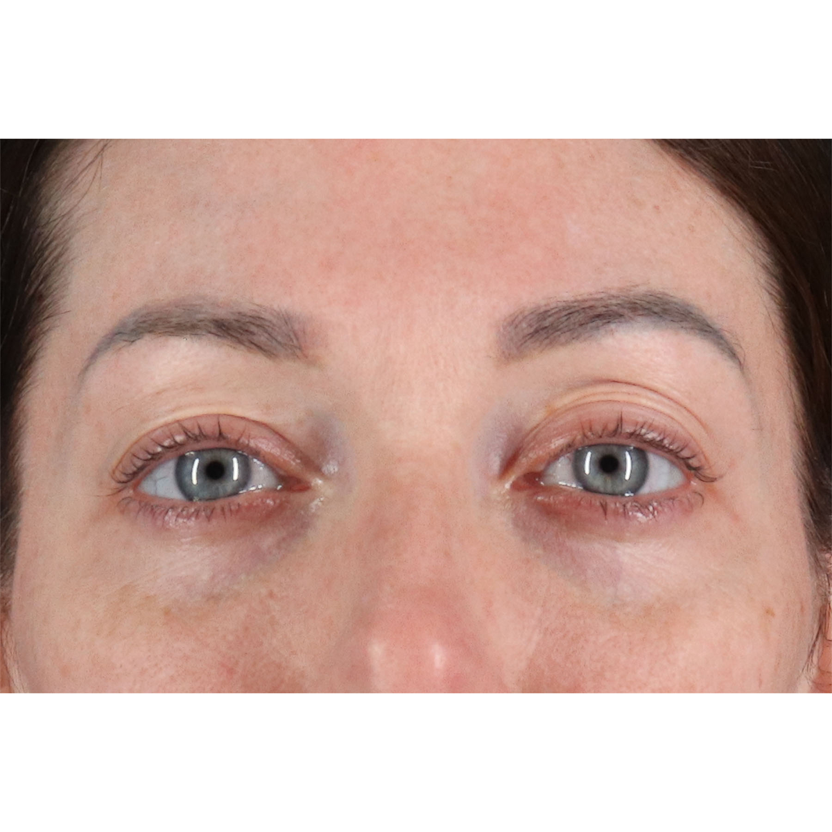 Blepharoplasty (Eyelid Surgery) Before & After Patient #11026