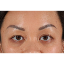 Blepharoplasty (Eyelid Surgery) Before & After Patient #11037