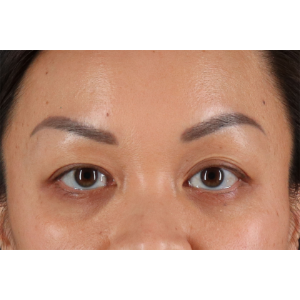 Blepharoplasty (Eyelid Surgery) Before & After Patient #11037