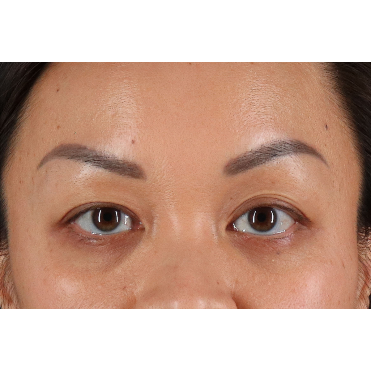 Blepharoplasty (Eyelid Surgery) Before & After Patient #11037