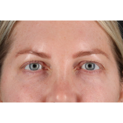 Blepharoplasty (Eyelid Surgery) Before & After Patient #11158
