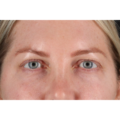 Blepharoplasty (Eyelid Surgery) Before & After Patient #11158