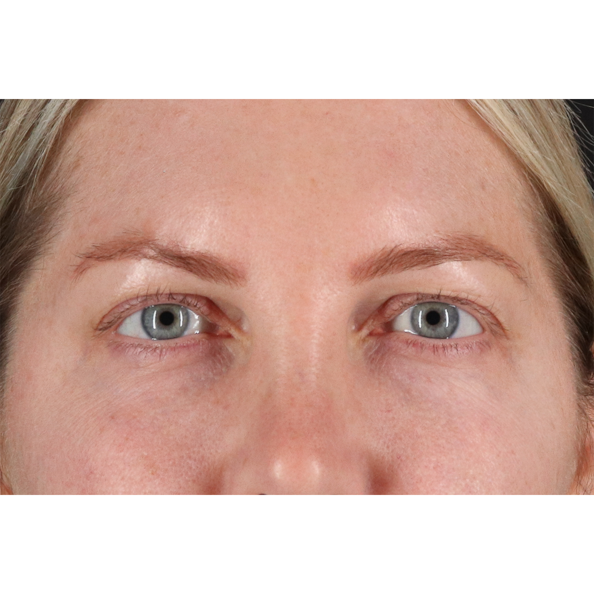 Blepharoplasty (Eyelid Surgery) Before & After Patient #11158