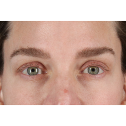 Blepharoplasty (Eyelid Surgery) Before & After Patient #11541