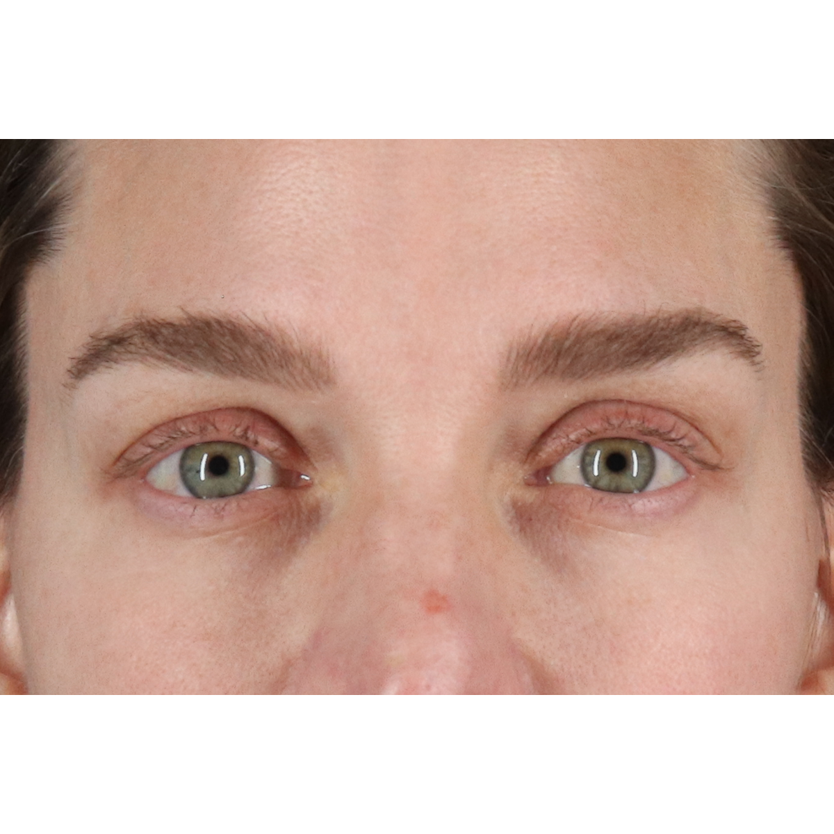 Blepharoplasty (Eyelid Surgery) Before & After Patient #11541