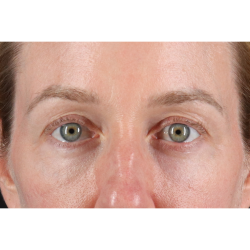 Blepharoplasty (Eyelid Surgery) Before & After Patient #11883