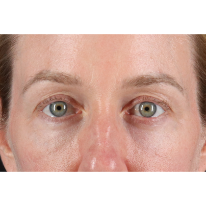 Blepharoplasty (Eyelid Surgery) Before & After Patient #11883