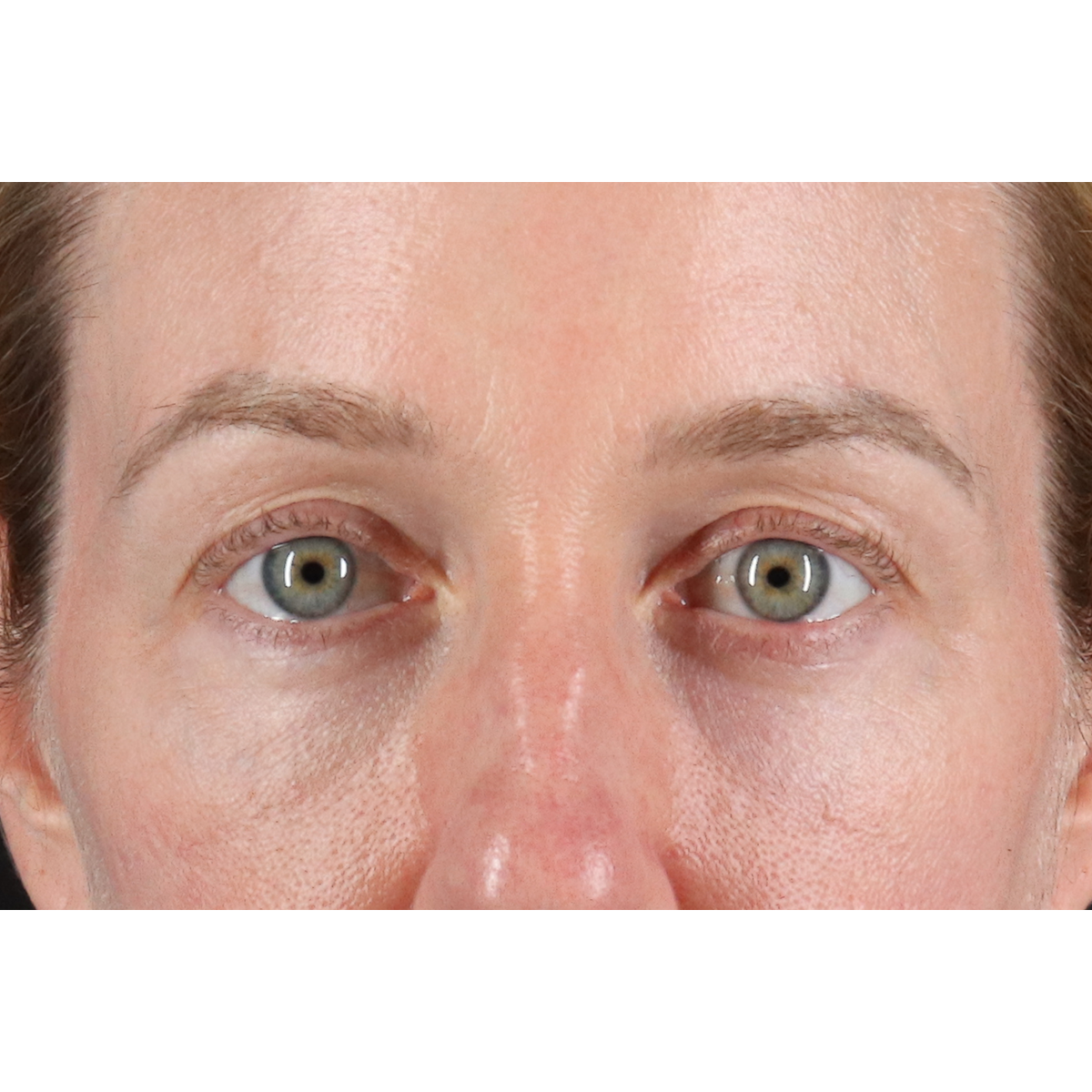 Blepharoplasty (Eyelid Surgery) Before & After Patient #11883