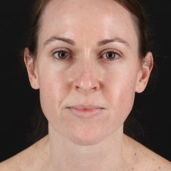 Fat Grafting To The Face Before & After Patient #11974