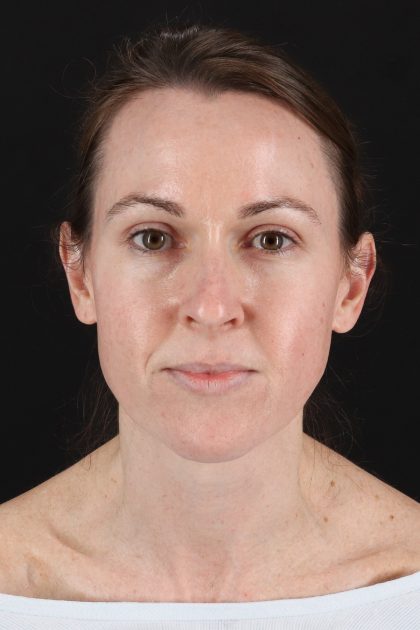 Fat Grafting To The Face Before & After Patient #11974