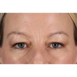 Blepharoplasty (Eyelid Surgery) Before & After Patient #11048